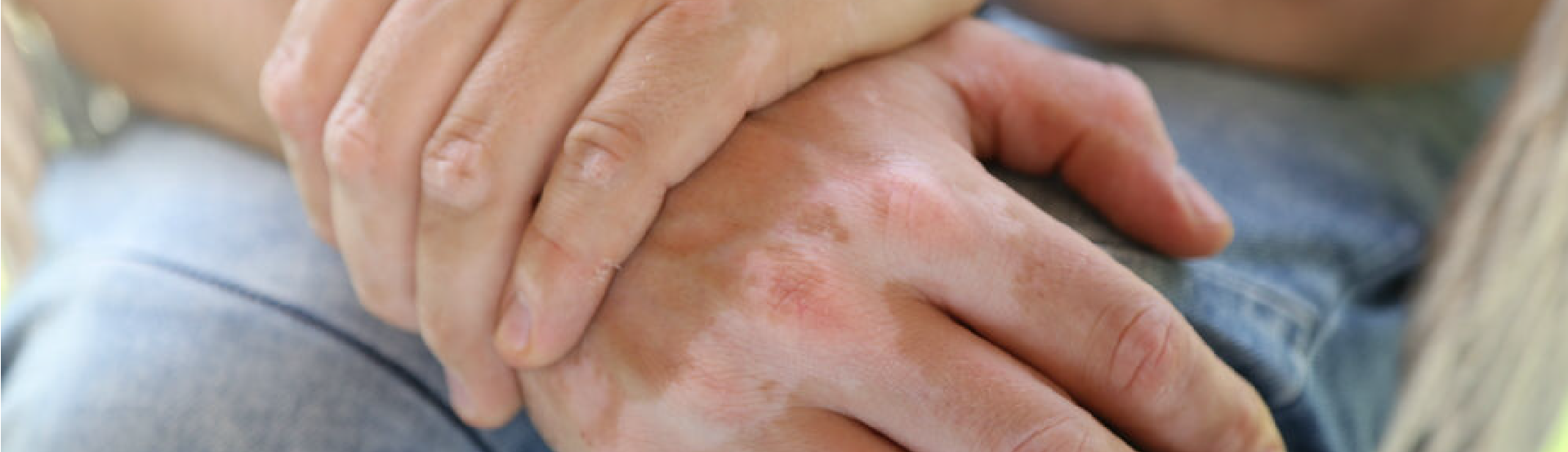 Vitiligine e malattie associate