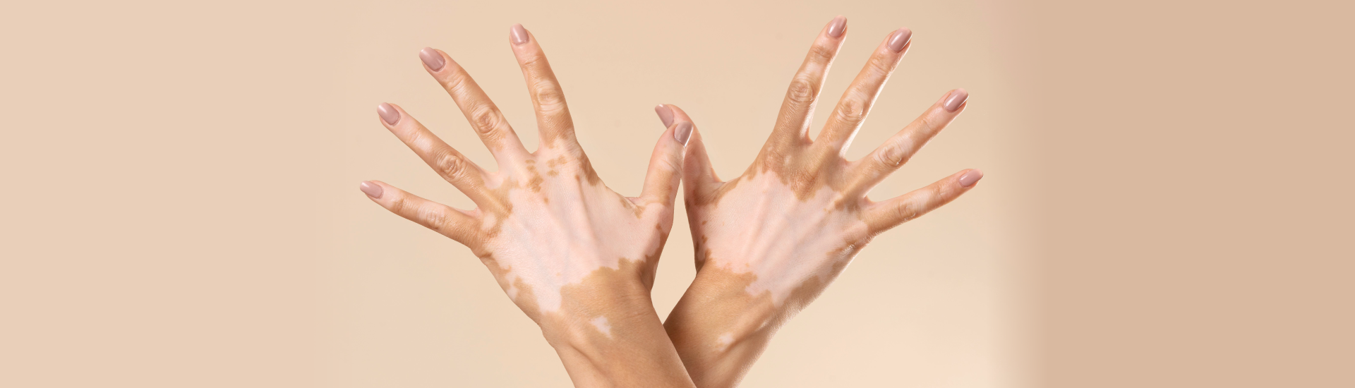 Ruxolitinib per la vitiligine: cosa dicono davvero gli studi clinici